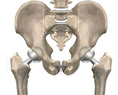 Artroplastia bilateral de quadril - Prótese de quadril - Ortopedista de Quadril