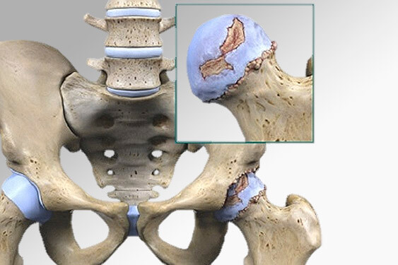 Doenças do quadril - Artrose de quadril - Ortopedista de Quadril