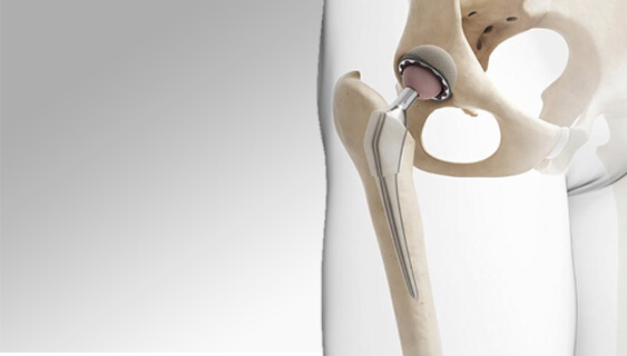 Cirurgia de quadril - Especialidade em ortopedia e traumatologia - Ortopedista de Quadril