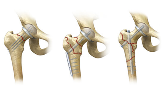 Traumas de quadril - Especialidade em ortopedia e traumatologia - Ortopedista de Quadril