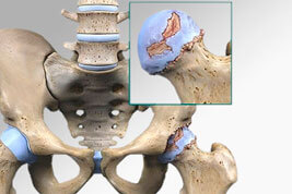 Artrose de quadril - Ortopedista de Quadril - 267x178