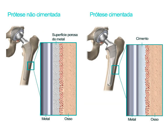 Prótese não cimentada e cimentada - Ortopedista de Quadril